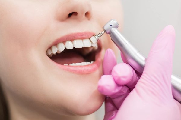 Peut-on obtenir un blanchiment dentaire chez Prisma Dentistes ?